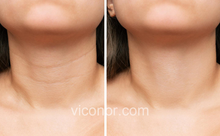 Load image into Gallery viewer, Viconor Infrared light therapy | 660nm&amp;850nm Red Light Therapy for Face and Body