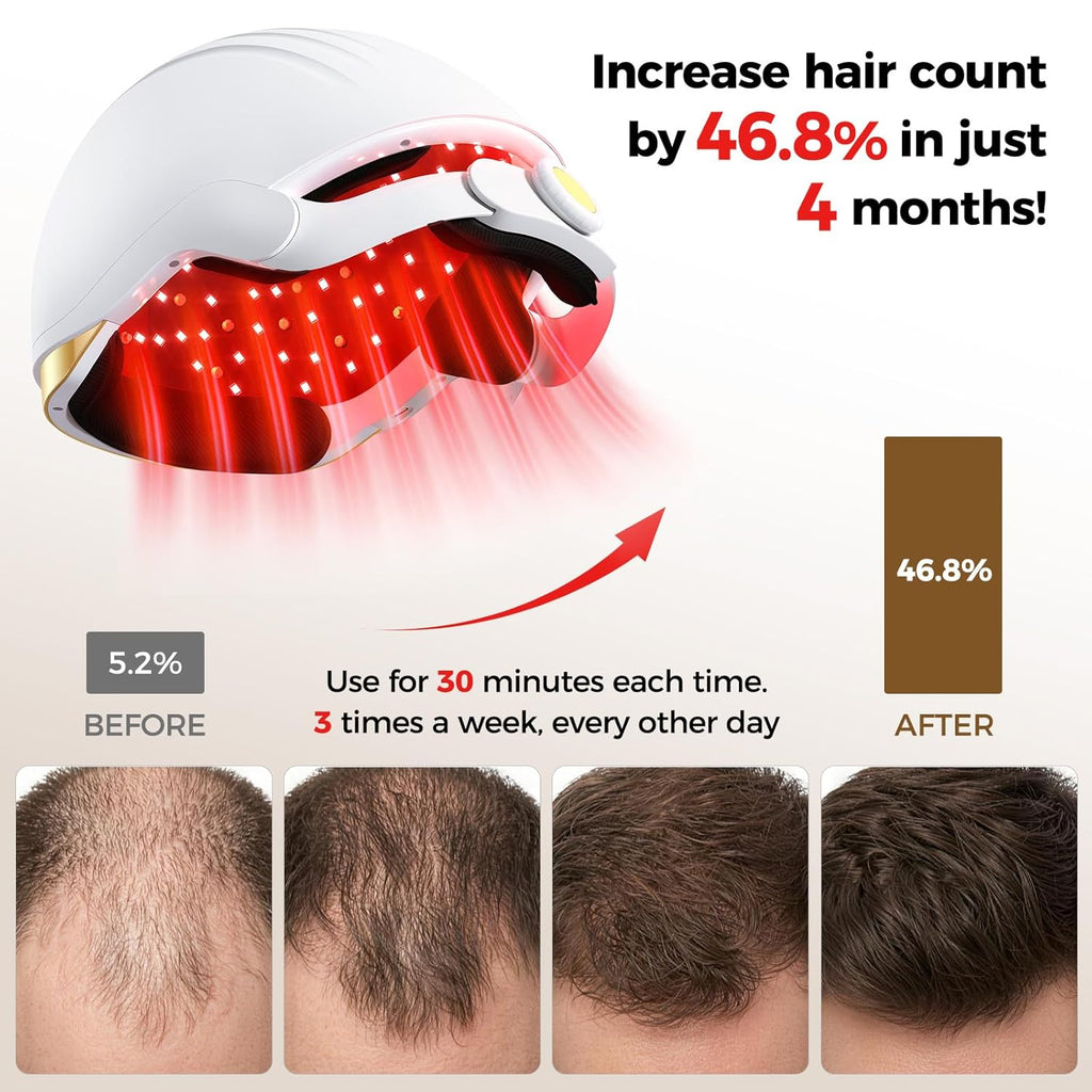 Viconor Infrared light therapy | for Hair Growth, FDA Cleared Hair Loss, 272 Lasers & LEDs.Treatment Options for Male and Female Hair Loss
