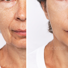 Load image into Gallery viewer, Viconor Infrared light therapy | 660nm&amp;850nm Red Light Therapy for Face and Body