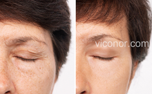 Load image into Gallery viewer, Viconor Infrared light therapy | 660nm&amp;850nm Red Light Therapy for Face and Body
